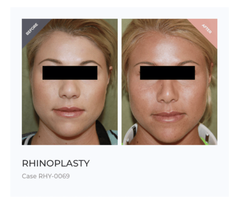 The Guide to Bulbous Nose Rhinoplasty | Wide Nasal Tip Surgery