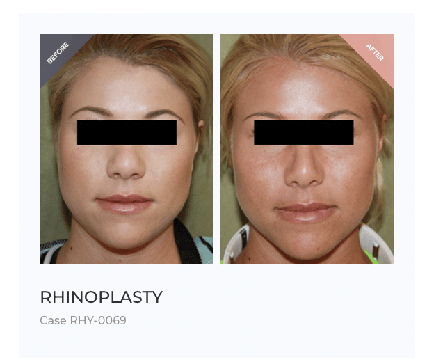 Bulbous Nose Rhinoplasty