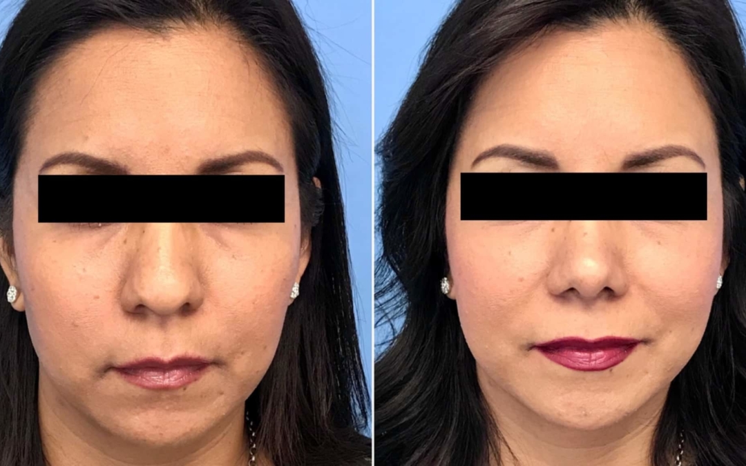 how to get nose slimmer without nose surgery｜TikTok Search