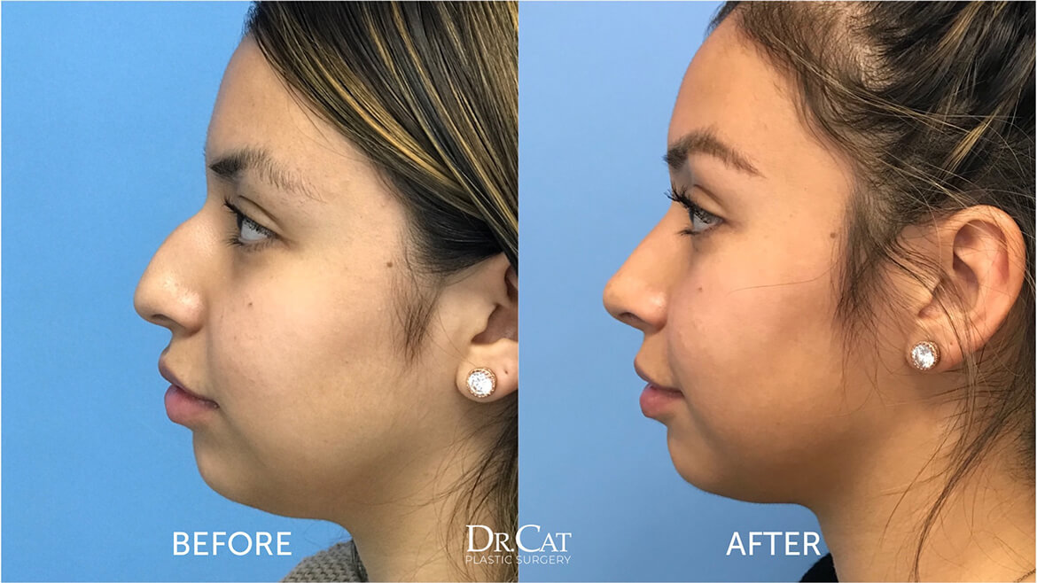 Rhinoplasty Before and After USA