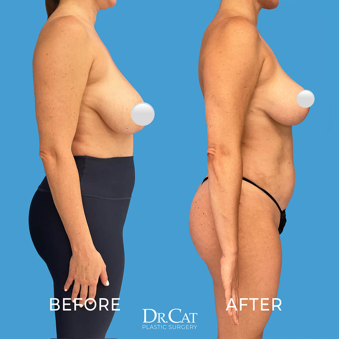 Common causes of saggy boobs including aging and pregnancy