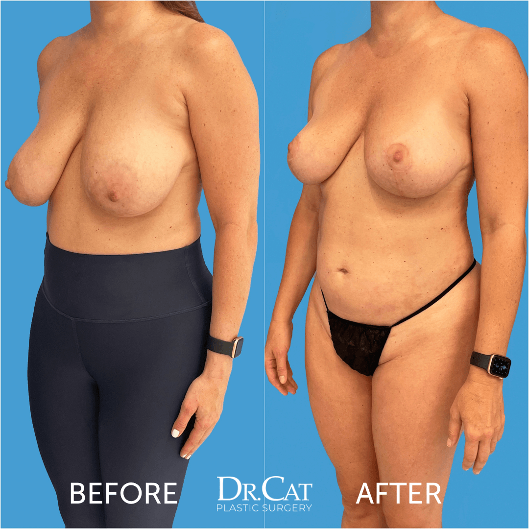 Solutions for saggy boobs including breast lift surgery options