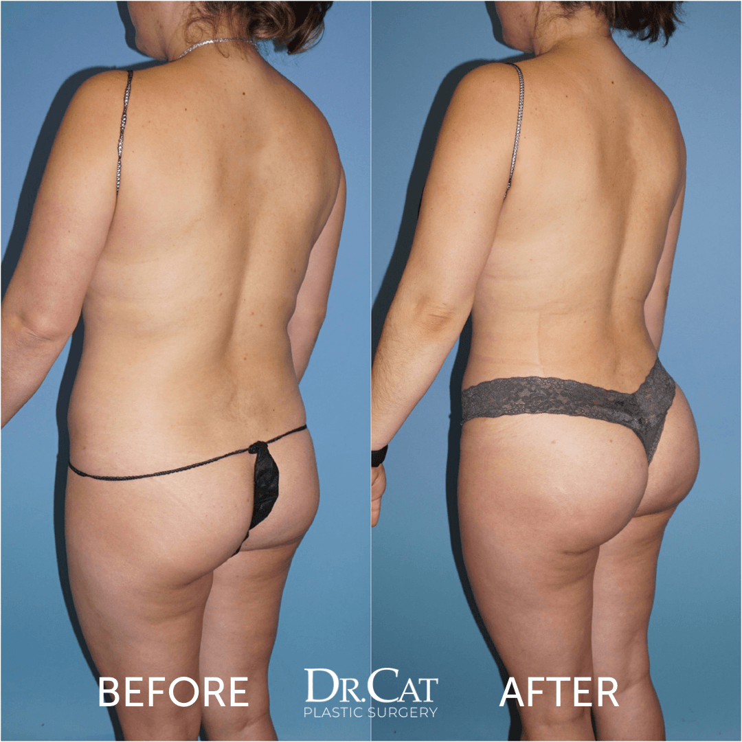 Sagging Butt: Causes, Solutions, and Treatment Options