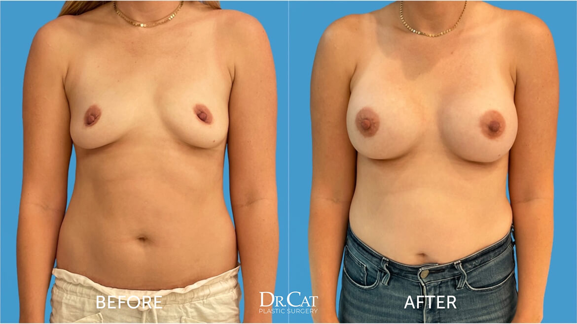 breast implants before and after 