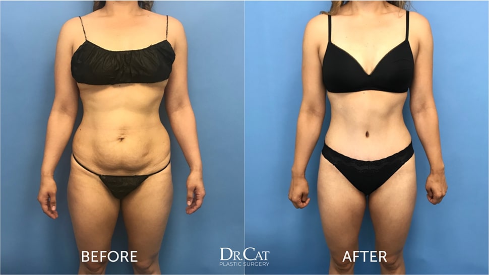 Tummy tuck before and after photos illustrating panniculectomy vs tummy tuck outcomes