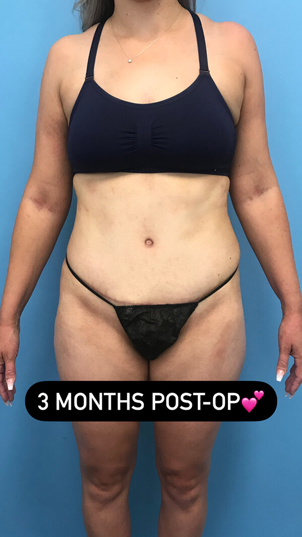 Three month tummy tuck recovery timeline showing final contour results