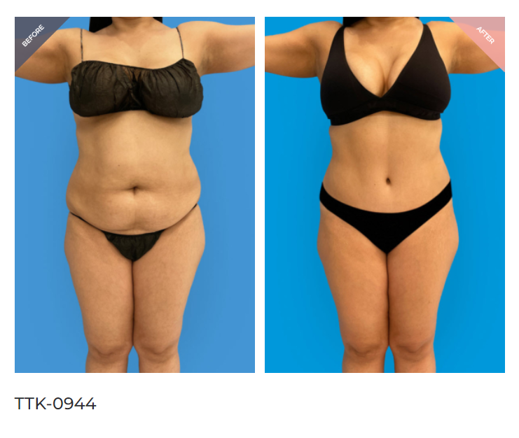 Tummy tuck before and after following the proper diet