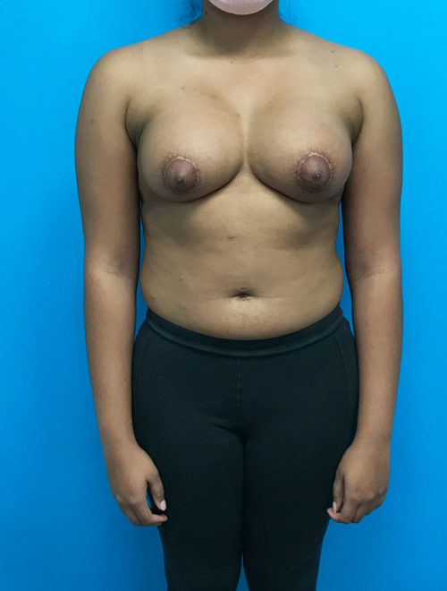 Tubular Breast Corrective Surgery Beverly Hills & LA