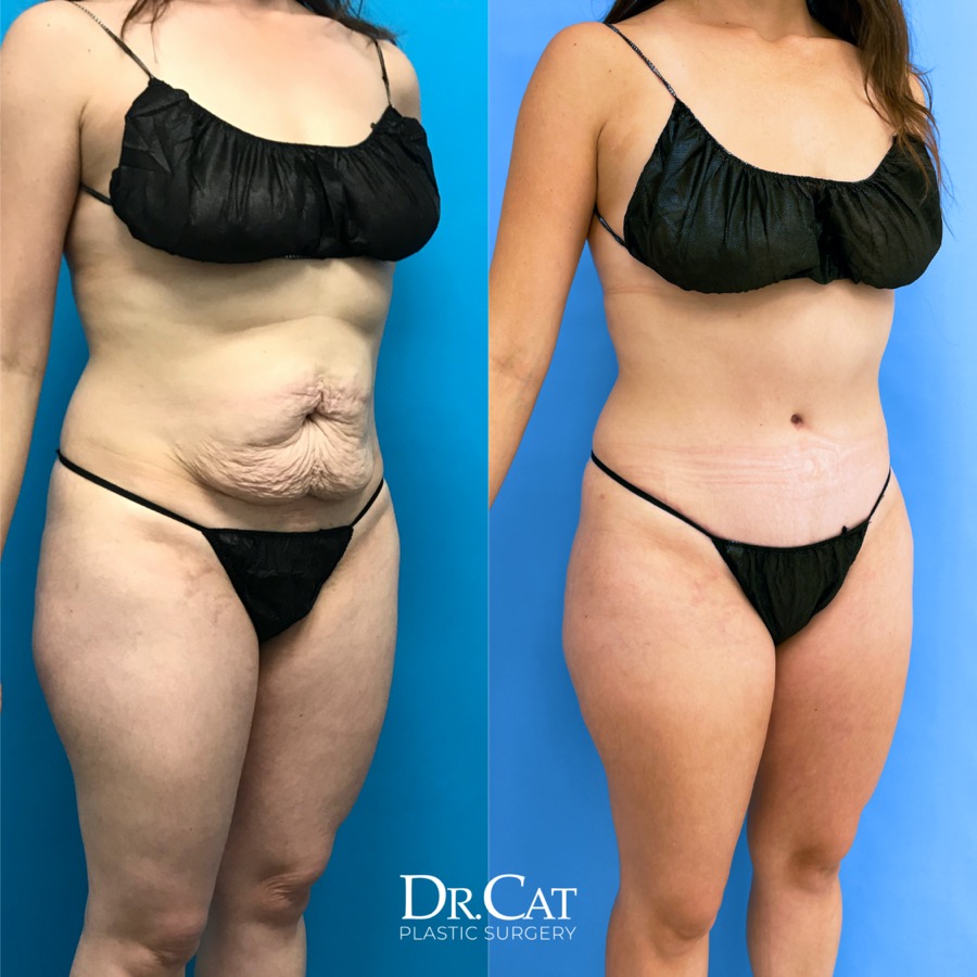 Tummy tuck beverly hills before after angle 10