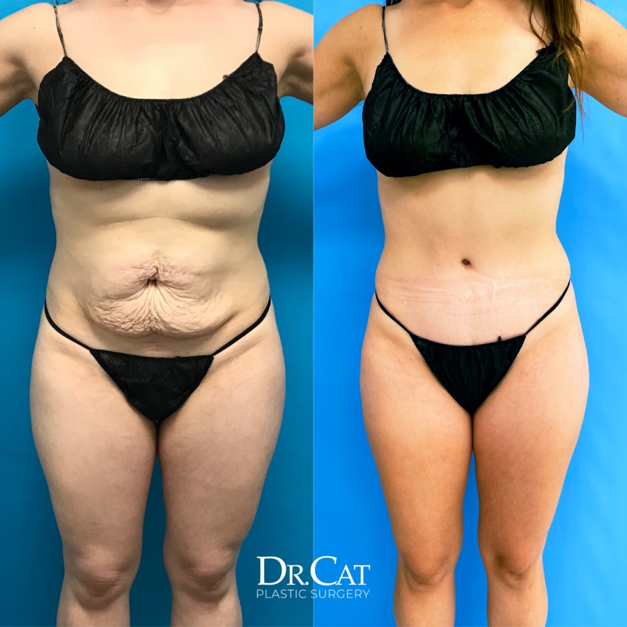 tummy-tuck-beverly-hills-before-after-front