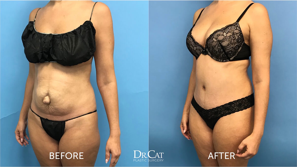 Tummy tuck health benefits