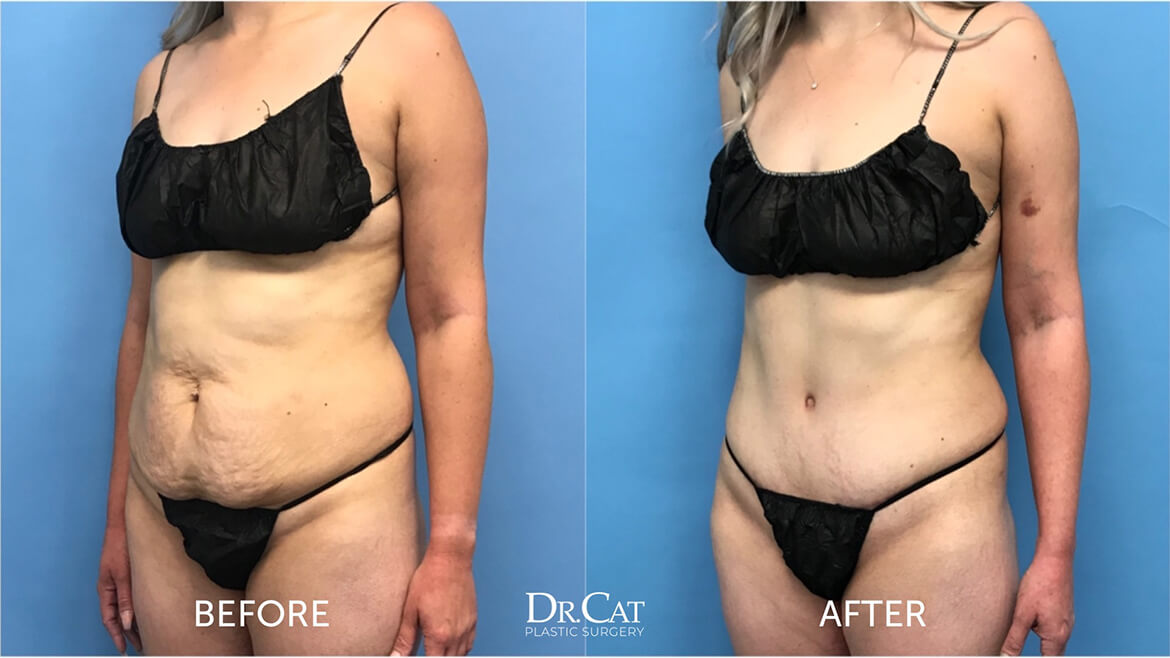 Tummy tuck recovery tips and week-by-week before and after progress