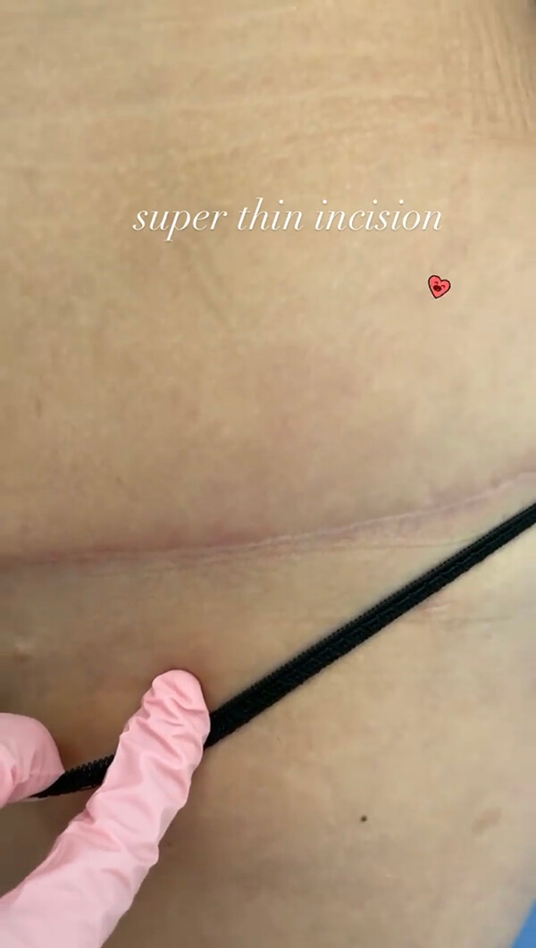 Super thin healed tummy tuck incision across the lower abdomen, pointer along the line, Dr. Cat patient