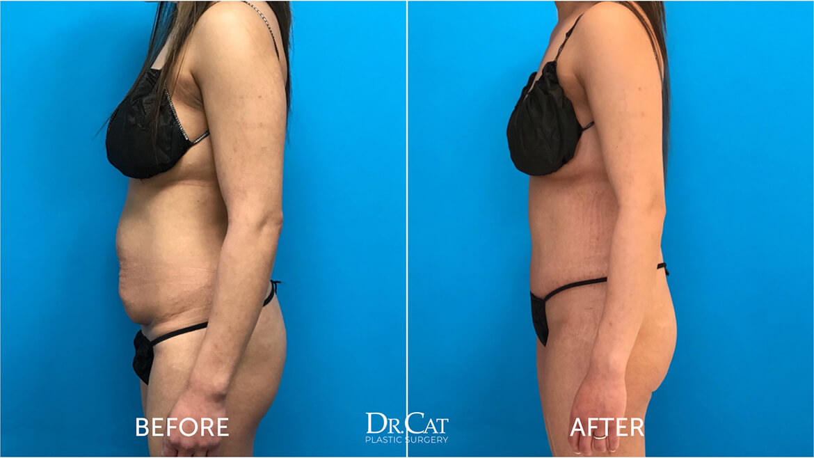 Flat tummy tuck before and after