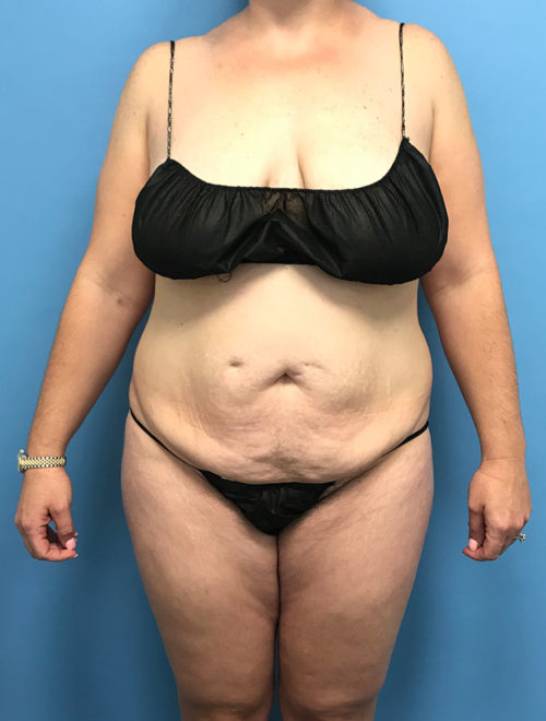 Lipo 360, Mons Pubis w/ Excision, Before and After
