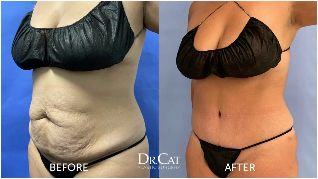 Can I Get a Breast Lift and a Tummy Tuck at the Same Time? - Dr