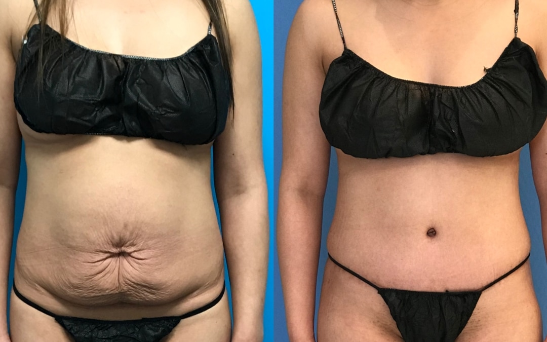 Tummy Tuck vs Liposuction: Which Do You Need?