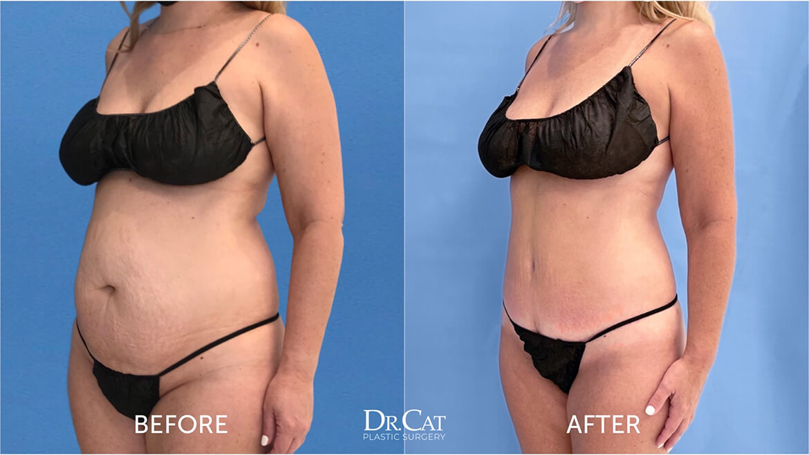 Tummy tuck long term results