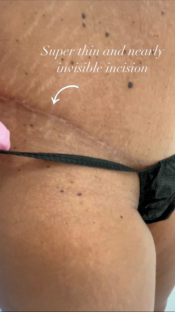 What Kind of Tummy Tuck Scar Should I Expect?