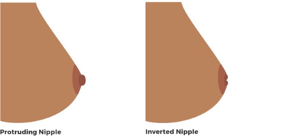 illustration comparing a protruding nipple to an inverted nipple