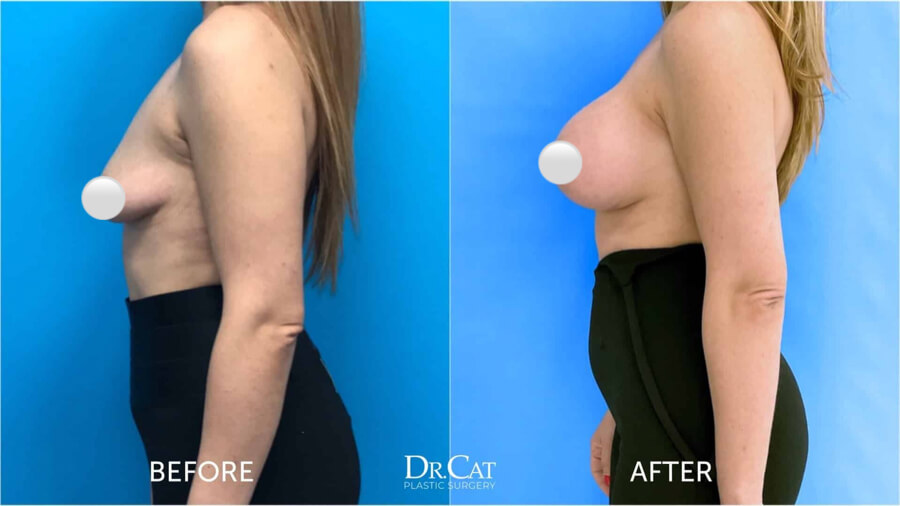 Under-muscle breast implant illustration showing potential complications and recovery considerations