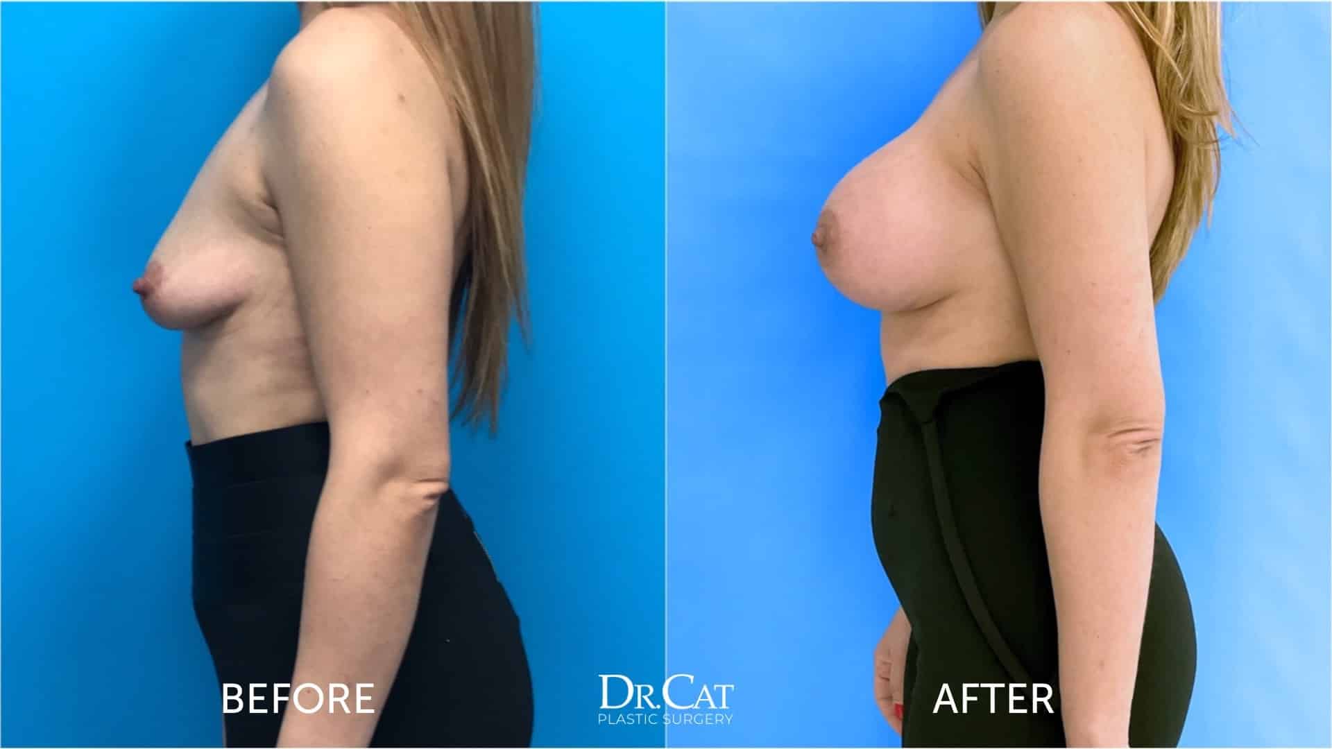 Risks with under the muscle breast implants 