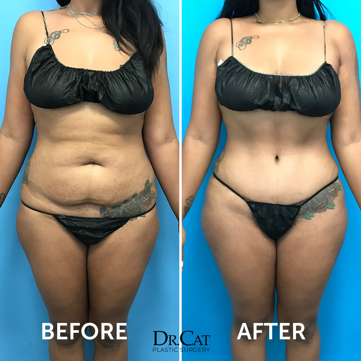 tummy tuck before and after example