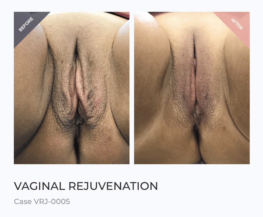Vaginal Rejuvenation Before and After
