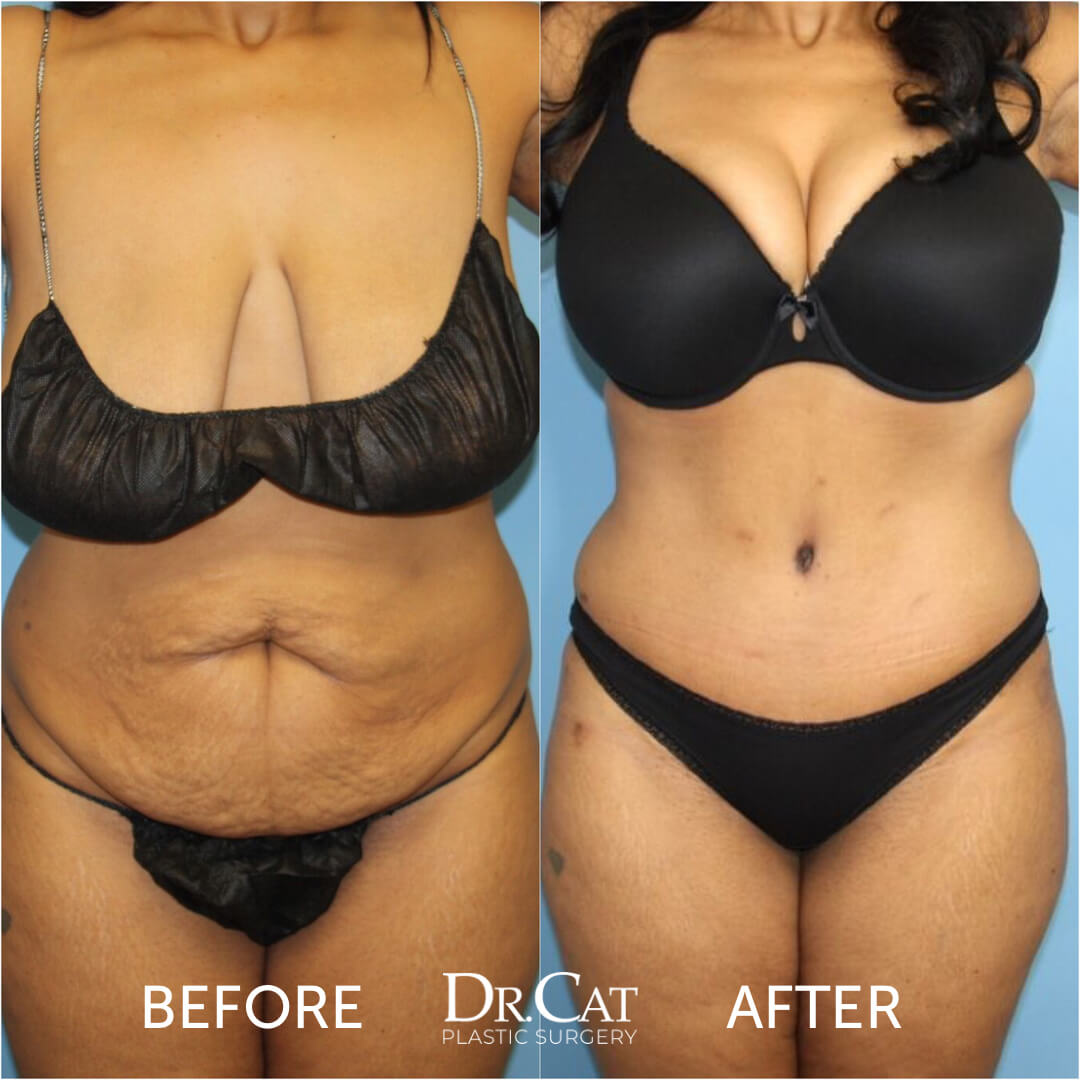 How Breast Lift and Breast Reduction Can Help Large Breasts