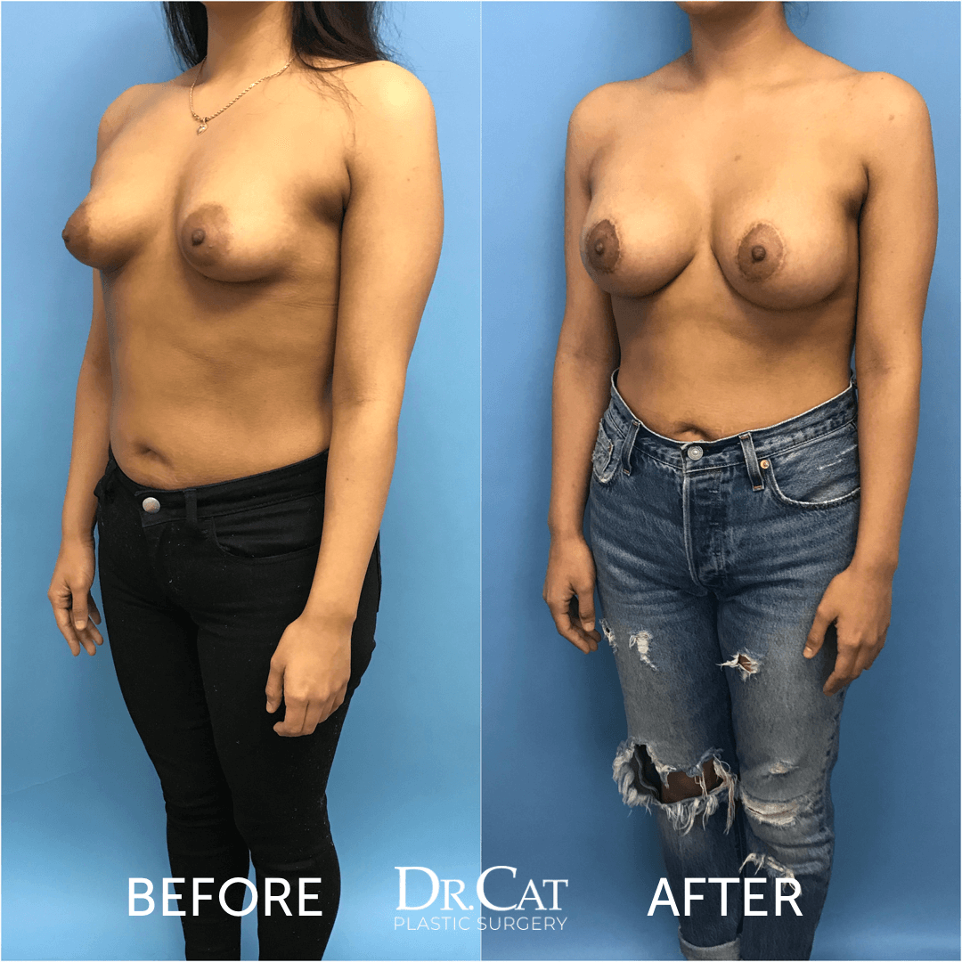 Puffy nipples before and after surgery
