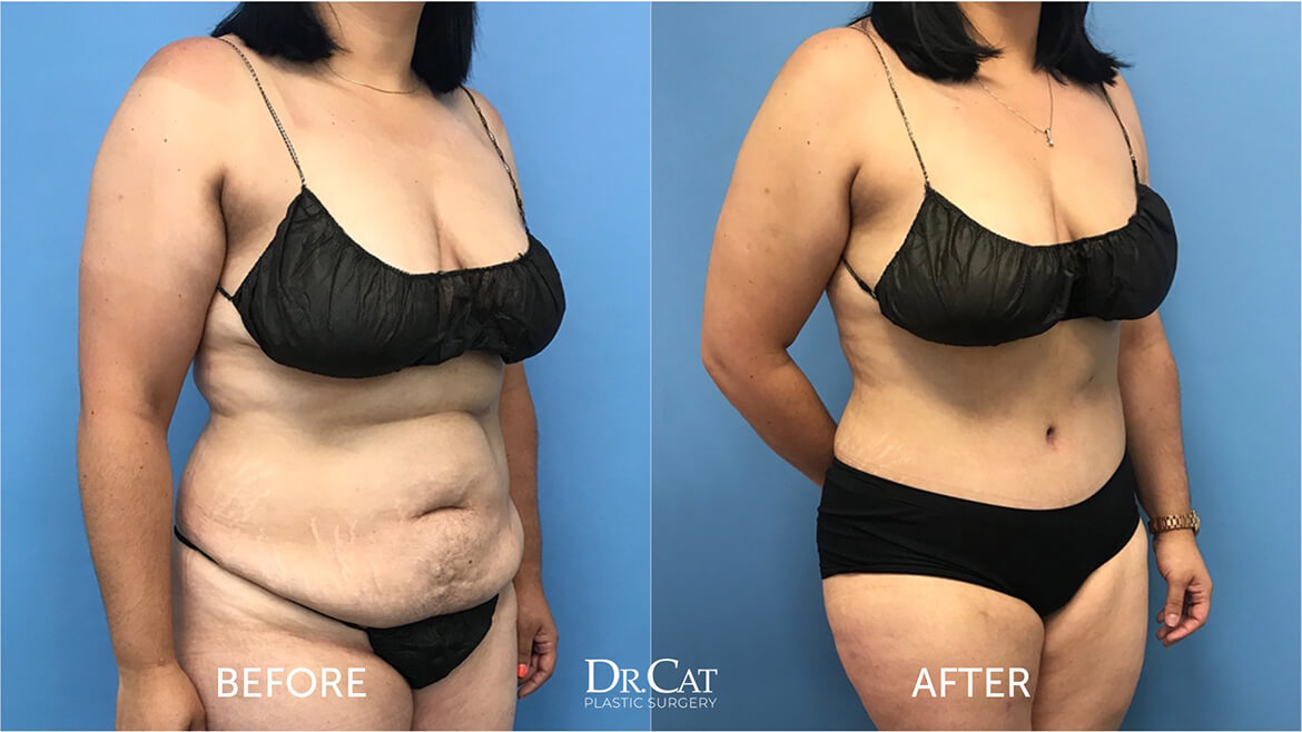 Tummy tuck BMI results