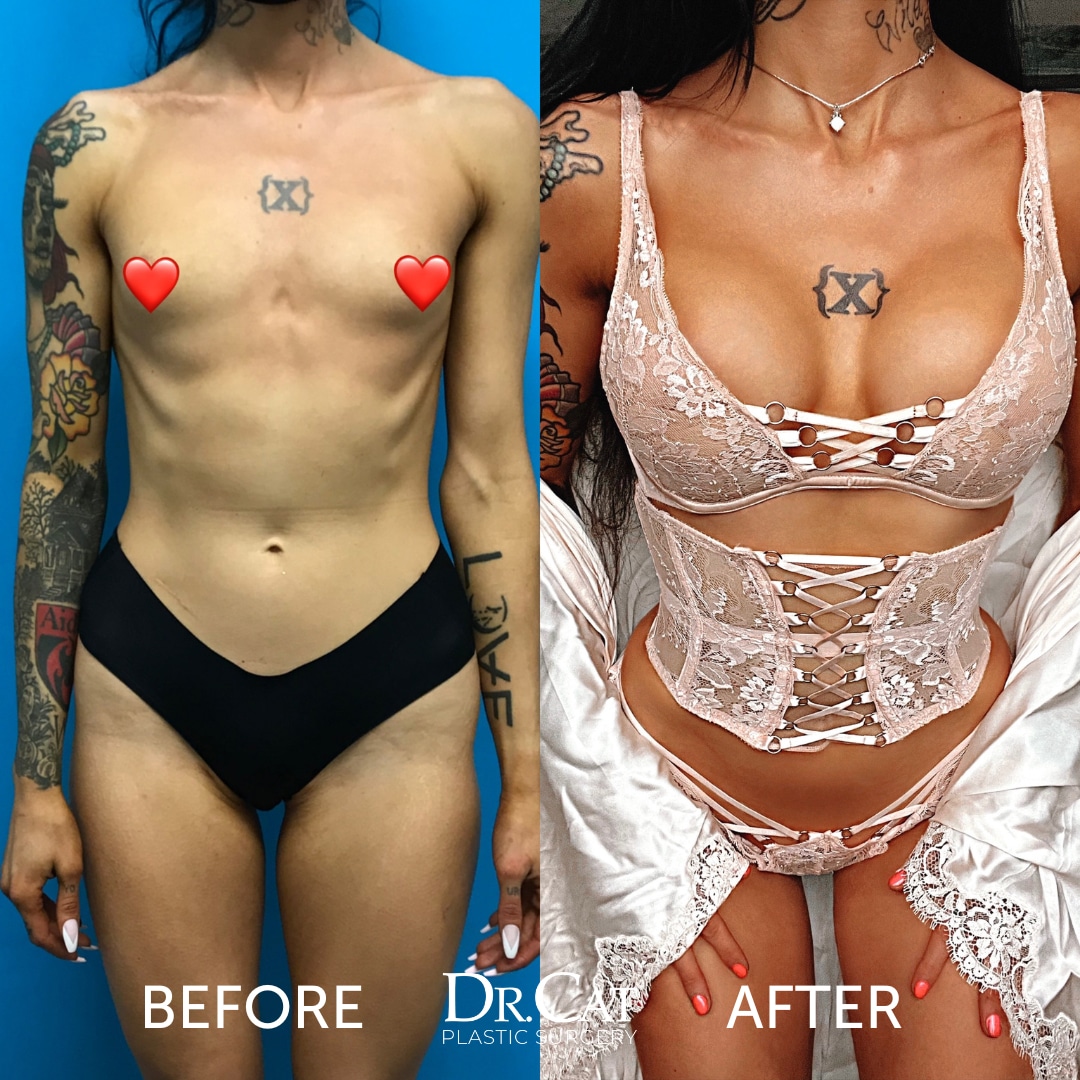 Andrew Trussler Breast Augmentation Surgery